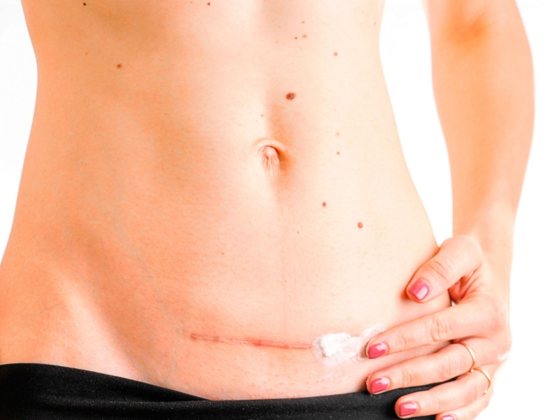 Tại sao cùng sinh mổ, người bị sẹo xấu, người lại không? 3