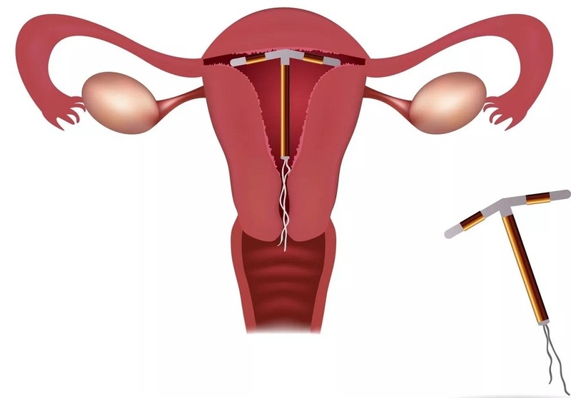 Tại sao đẻ mổ không nên đặt vòng tránh thai? Nên ngừa thai bằng phương pháp nào? 3