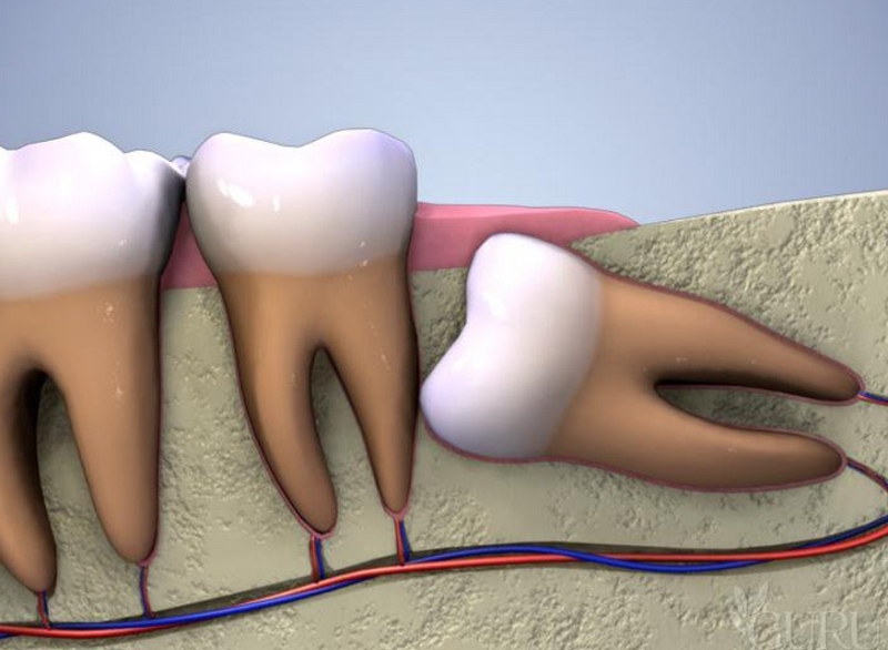 Tại sao gọi là răng khôn? Lý do phần lớn răng khôn phải nhổ bỏ là gì? 3