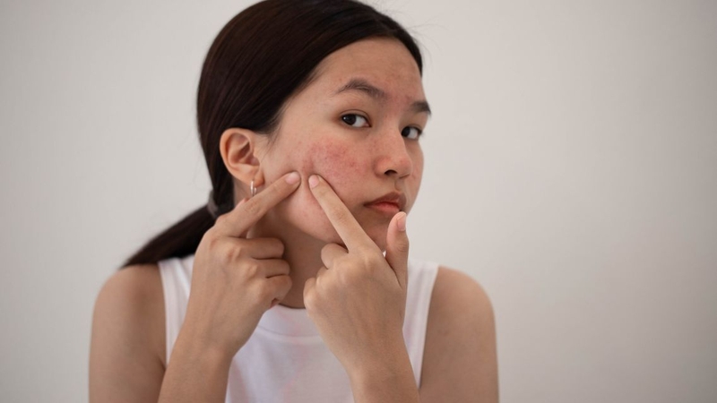 Nhiều người không biết&nbsp;tại sao khi yêu lại nổi mụn