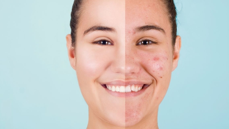 Chăm sóc da đúng cách và kiểm soát dầu nhờn giúp hạn chế nguy cơ nổi mụn