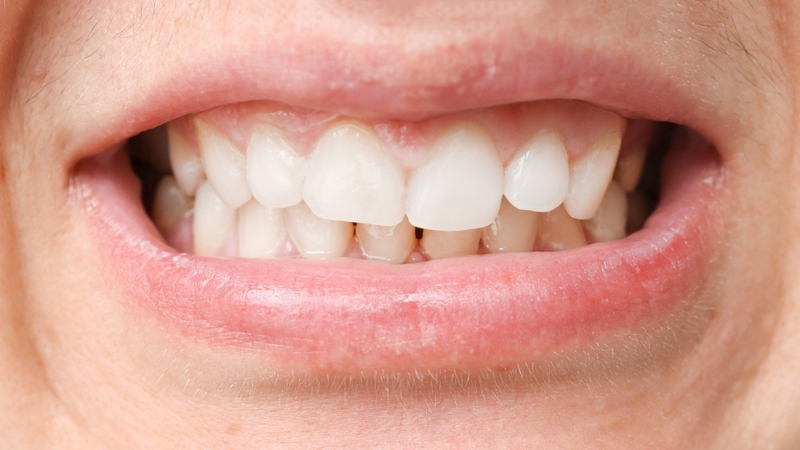 Tại sao khuôn mặt bị lệch khi chụp ảnh? Có cách nào khắc phục không? 2