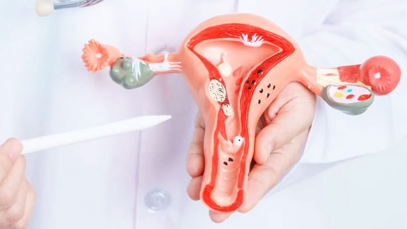 Những vấn đề về cấu trúc tử cung có thể ảnh hưởng đến chu kì kinh nguyệt