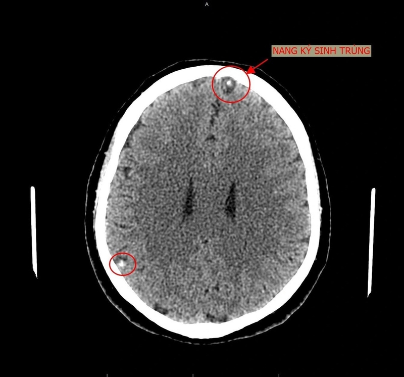Tại sao lại nhiễm ký sinh trùng não? -2