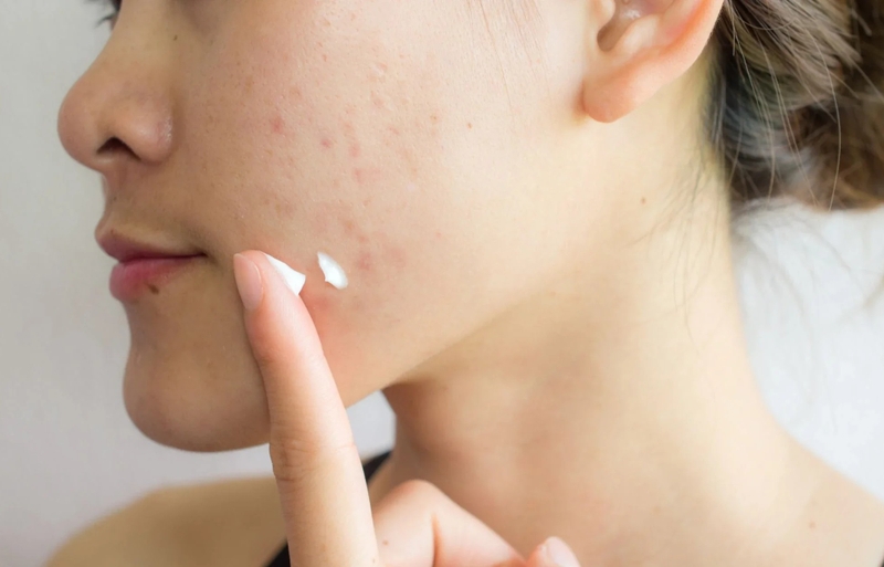 Benzoyl Peroxide không chỉ hỗ trợ trị mụn mà còn giảm thâm sau mụn