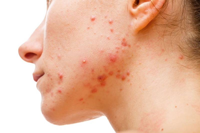 Người bị mụn trứng cá nặng không nên dùng Benzoyl Peroxide
