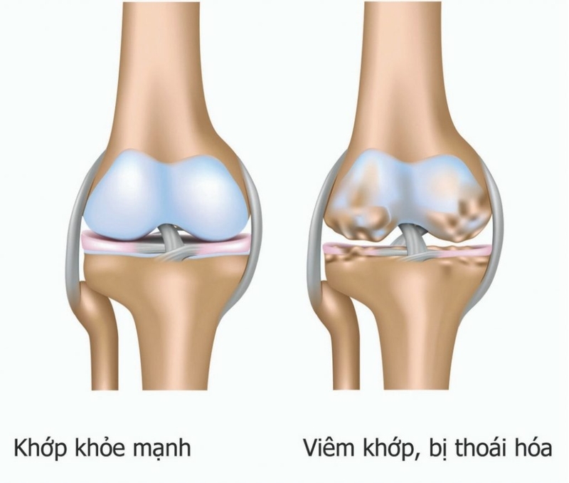 Giải đáp: tại sao người già dễ bị gãy xương? 1