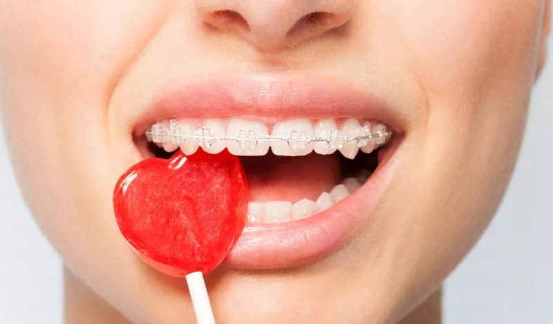 Tại sao niềng răng lại bị hóp má và cách khắc phục hiệu quả? 2