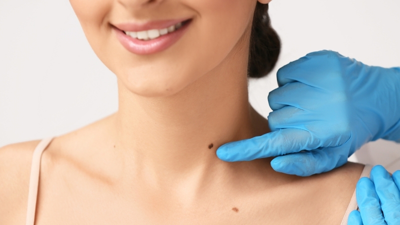 Ánh nắng kích thích sản xuất melanin khiến nốt ruồi đậm màu và dễ xuất hiện nốt ruồi mới