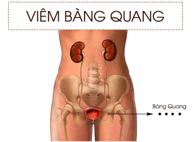 Tại sao nữ giới dễ mắc bệnh viêm bàng quang 1