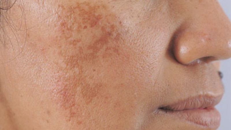 Tại sao ở trong nhà không ra nắng mà da vẫn bị đen sạm? 1