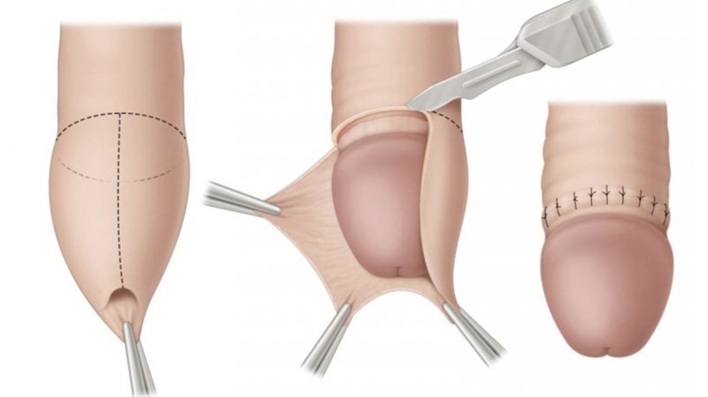 Tại sao phải cắt bao quy đầu? Khi nào cần thực hiện cắt bao quy đầu? 3