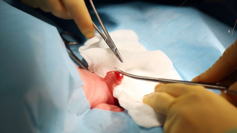 Tại sao phải cắt bao quy đầu? Khi nào cần thực hiện cắt bao quy đầu? 5