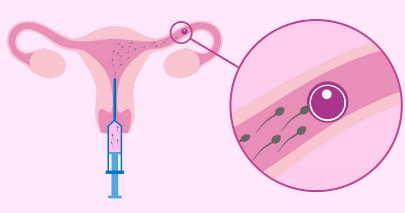 Tại sao phải nhịn tiểu trước khi IUI? Những lưu ý về IUI cần biết 1