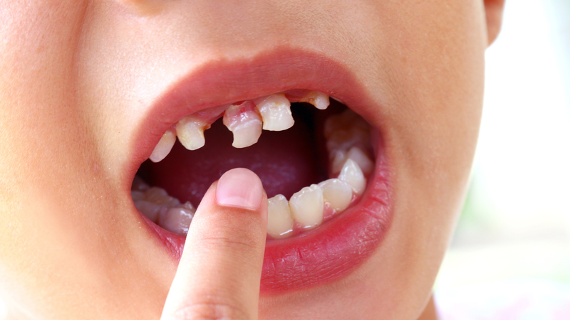Răng sữa chưa rụng nhưng răng vĩnh viễn đã mọc lên có thể xuất phát từ nhiều nguyên nhân khác nhau