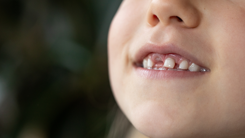Quá trình thay răng là một bước phát triển tự nhiên của trẻ