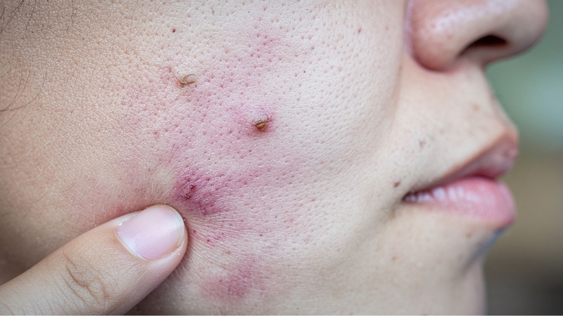 Lựa chọn sản phẩm không phù hợp khiến da bị kích ứng nổi mụn