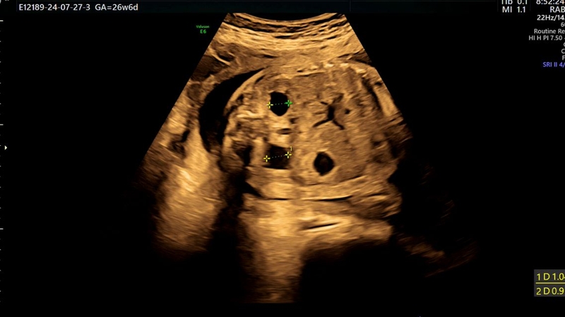Hình ảnh siêu âm thai nhi bị giãn bể thận do thận ứ nước