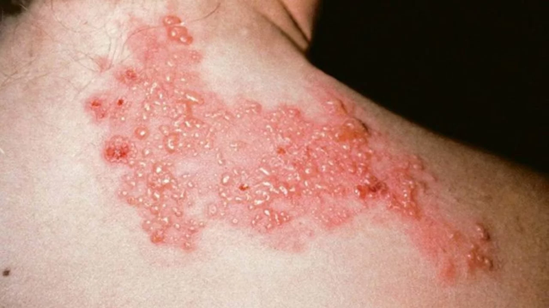 Tại sao tiêm vắc xin thủy đậu tốt hơn là mắc bệnh? 2