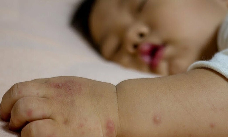 Trẻ bị tay chân miệng hay giật mình có nguy hiểm không? 1