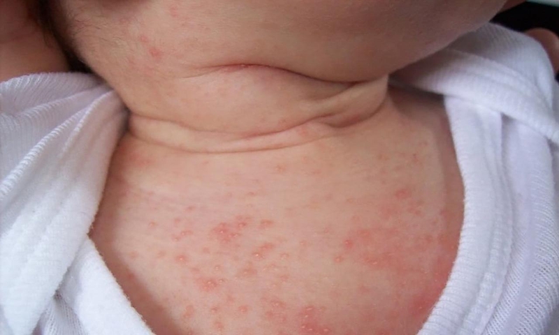 Phần da vùng cổ có nhiều nếp gấp nên mồ hôi và bụi bẩn dễ đọng lại tại những nếp gấp ở cổ