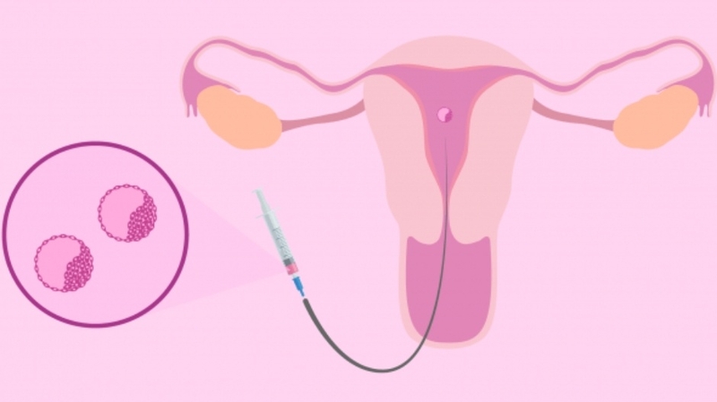 Tại sao trước khi chuyển phôi phải nhịn tiểu? Những lý do quan trọng bạn cần biết 3