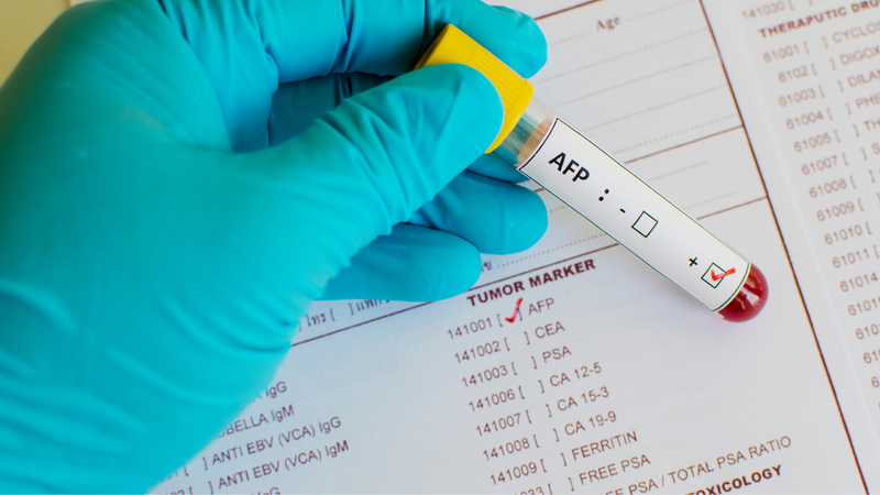 Tại sao ung thư gan khó phát hiện? 3