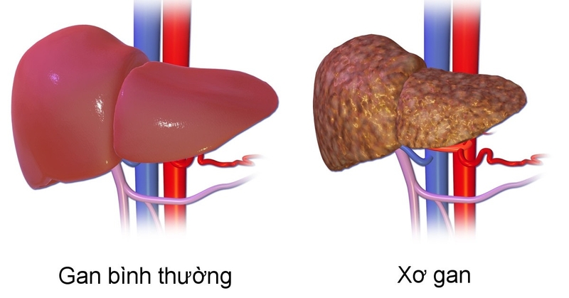 Tại sao xơ gan gây hạ natri máu? 1