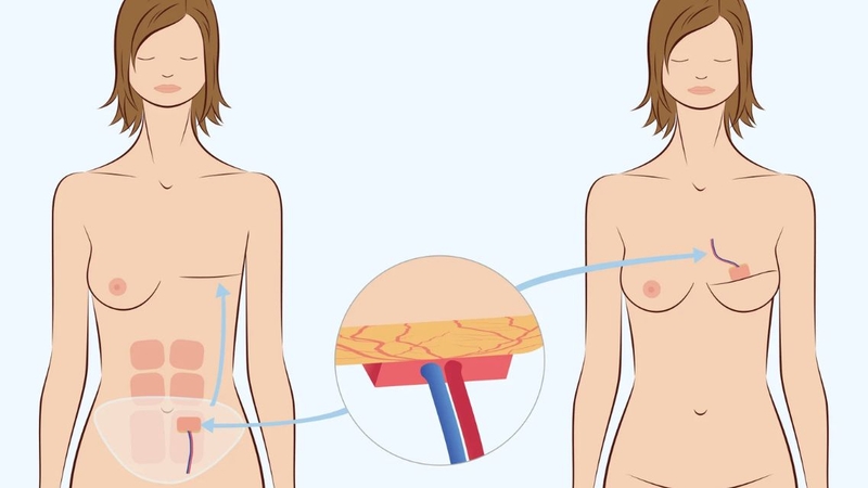 Vạt tự thân có tương thích cao, tạo bầu ngực tự nhiên và duy trì hiệu quả thẩm mỹ lâu dài