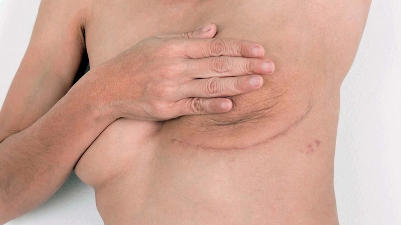 Tái tạo vú có thể được thực hiện bằng túi độn, mô tự thân hoặc kết hợp cả hai
