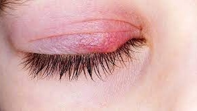 viem-bo-mi-can-kieng-an-gi-de-mau-chong-phuc-hoi-suc-khoe-hieu-qua-1