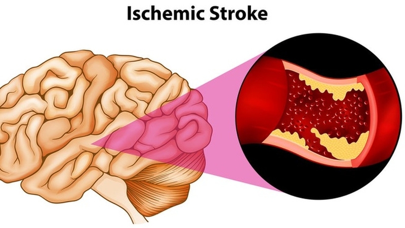Tắm khuya có thực sự liên quan đến đột quỵ: Sự thật hay chỉ là tin đồn? 2