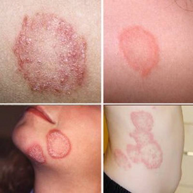 Tắm lá gì để trị hắc lào nhanh chóng và hiệu quả 2