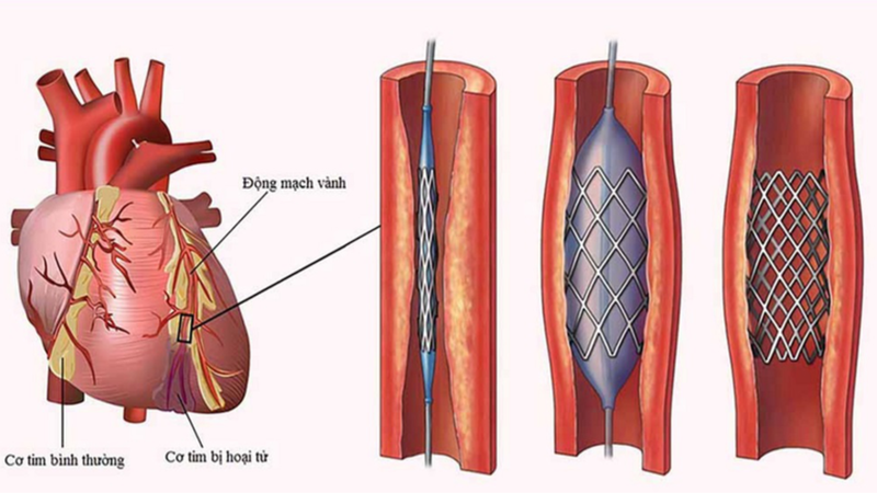Tầm quan trọng của phân suất dự trữ lưu lượng động mạch vành (FFR) trong việc chẩn đoán và điều trị bệnh lý mạch vành 3