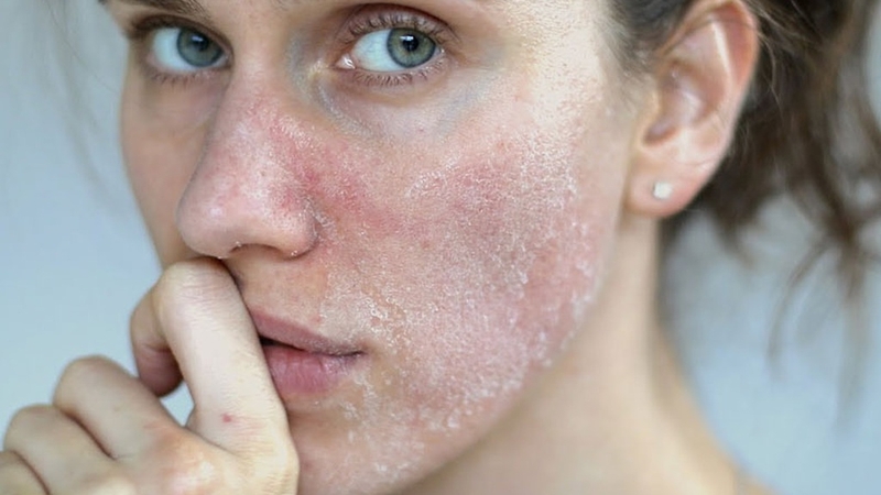 Tầm quan trọng của việc bổ sung nước đối với làn da 4