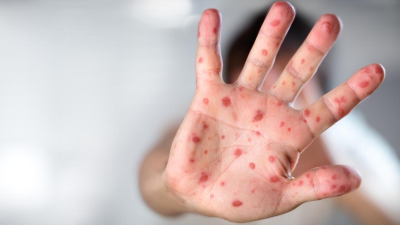 Tầm quan trọng của xét nghiệm Rubella ở thai phụ1