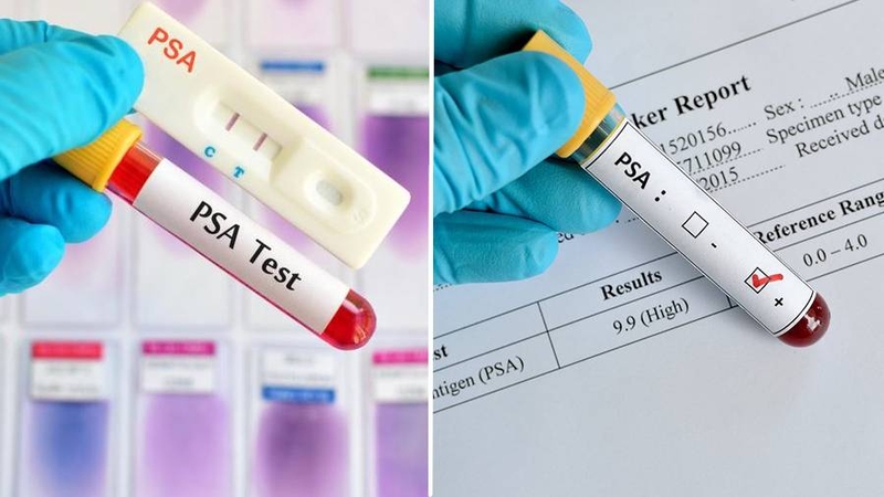Xét nghiệm PSA là một trong những phương pháp tầm soát ung thư tuyến tiền liệt