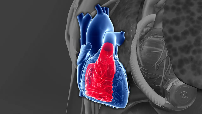 Tâm thất trái hoạt động bất thường gây ảnh hưởng lớn đến sức khỏe