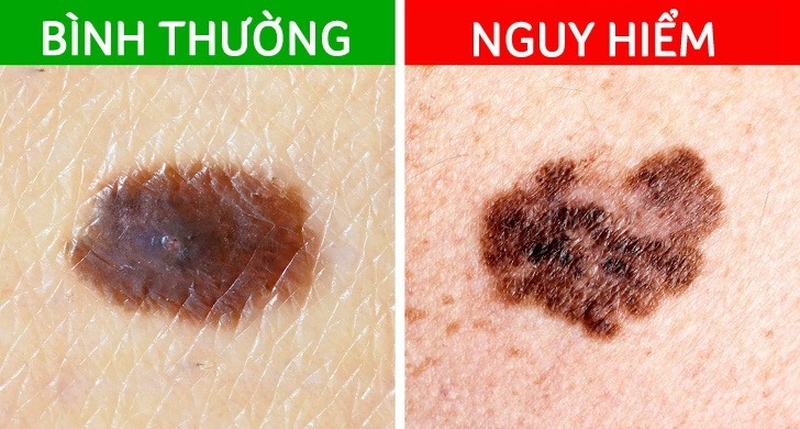Tàn nhang có phải nốt ruồi không? Những điểm khác biệt của tàn nhang và nốt ruồi 3