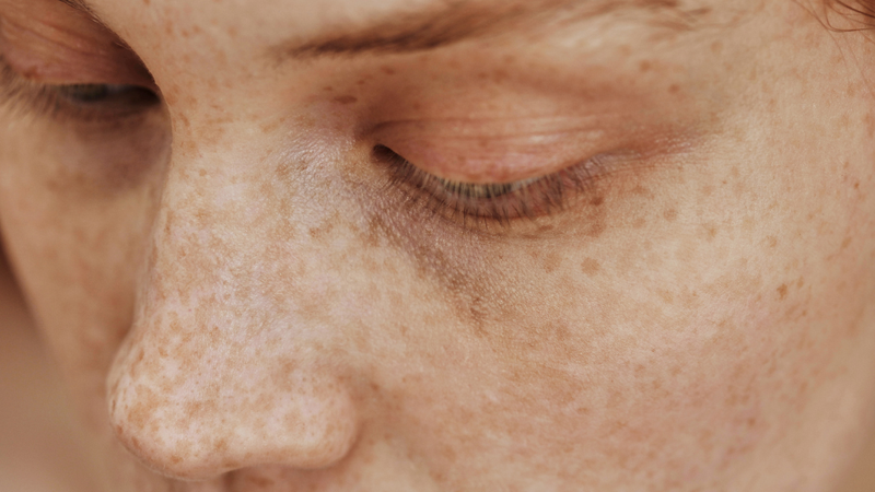 tan-nhang-co-tri-duoc-khong-cac-phuong-phap-dieu-tri-tan-nhang-theo-y-khoa-hien-dai 1