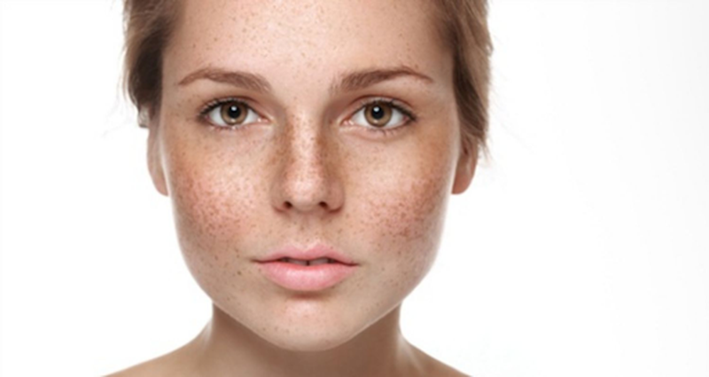 Giải đáp thắc mắc có chữa được tàn nhang di truyền hay không 1