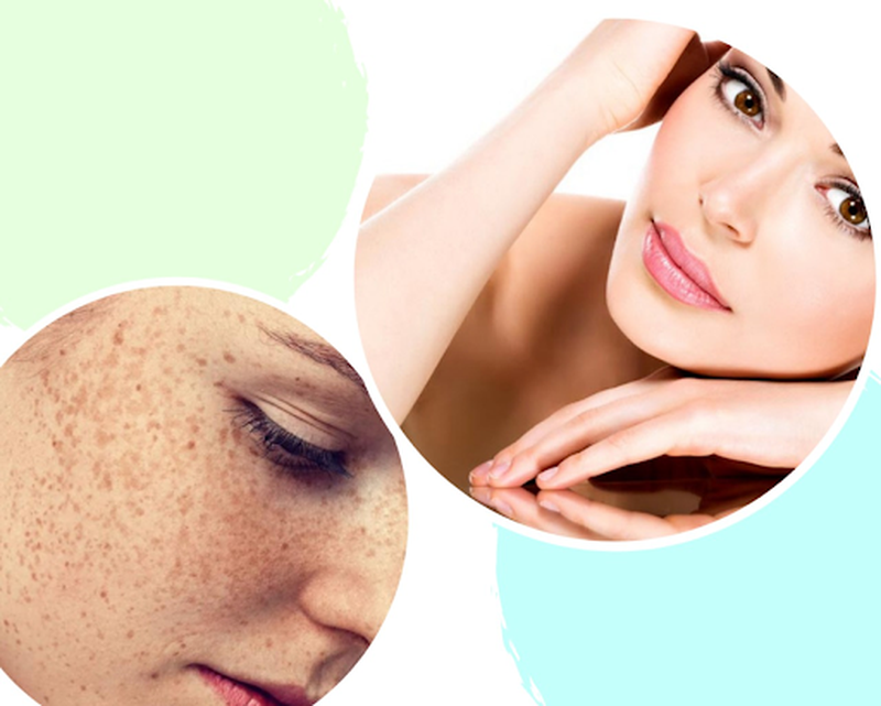 Tàn nhang đốm nâu - nỗi lo sợ của chị em phụ nữ4