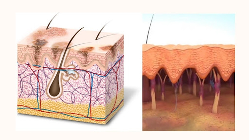 Bạn có biết tàn nhang được hình thành như thế nào không?