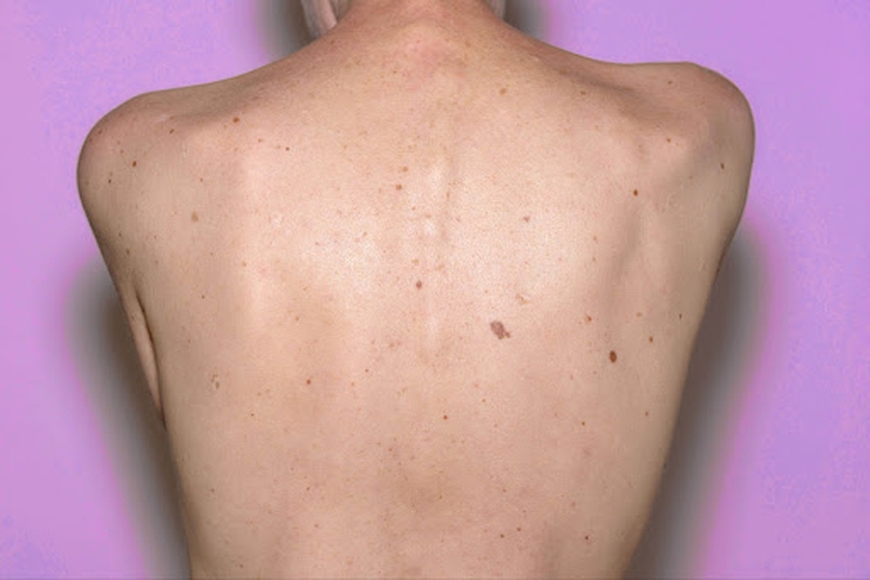 Tàn nhang trên lưng và cách điều trị hiệu quả nhất 2