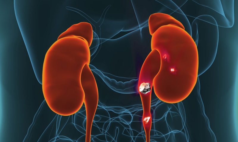 Tán sỏi niệu quản bằng laser giá bao nhiêu? Ưu, nhược điểm tán sỏi bằng laser 1