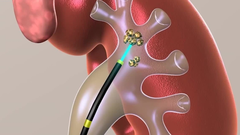 Tán sỏi niệu quản bằng laser giá bao nhiêu? Ưu, nhược điểm tán sỏi bằng laser 3