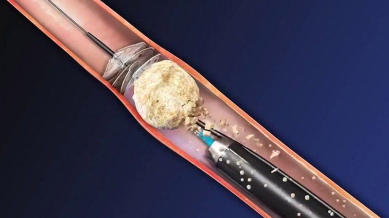 Tán sỏi niệu quản bao lâu thì khỏi là nỗi băn khoăn của nhiều độc giả