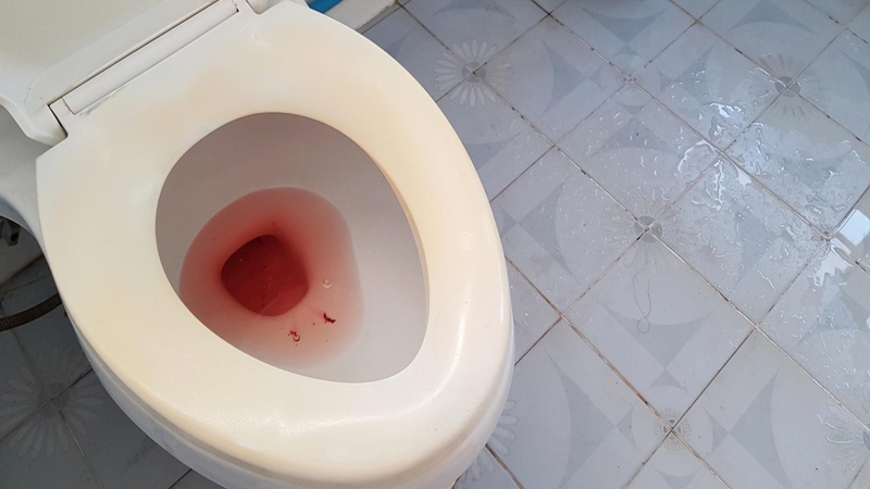 Tán sỏi niệu quản có ảnh hưởng gì không? 3