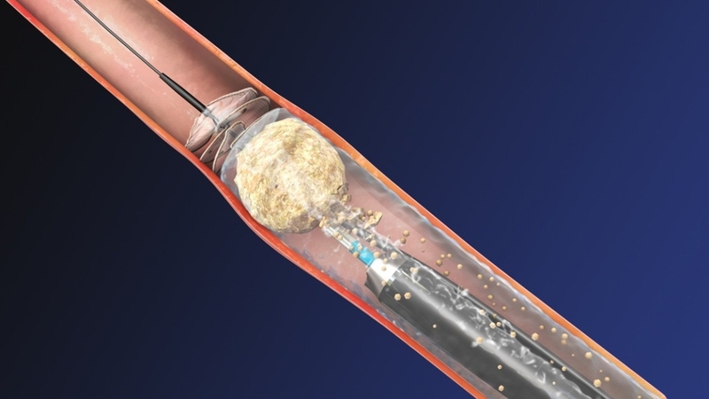 tan-soi-noi-soi-nguoc-dong-bang-laser-la-gi 1.jpg