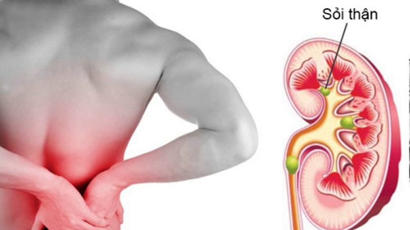 Vitamin C gây sỏi thận hay không?  1